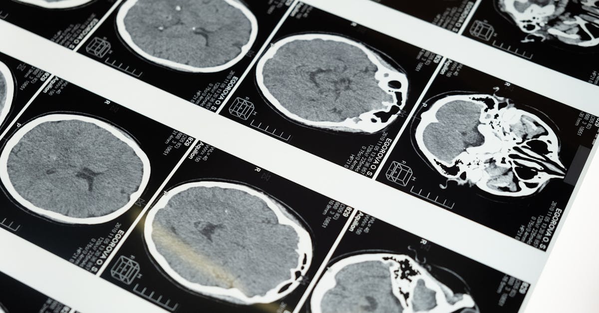 Detailed brain MRI scans displayed on a lightbox, showcasing medical imaging techniques.